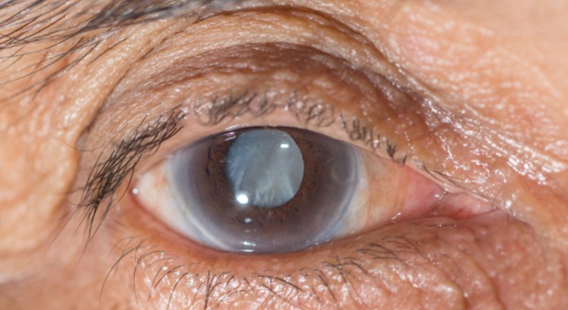 Grauer Star - MR Dr. med. univ. Johannes Kopatschka - Augenarzt Wien 1220