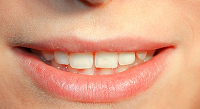 Sofortversorgung bei Zahnverlust