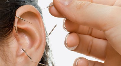 Ohrakupunktur