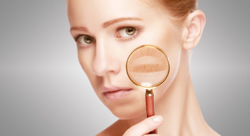 Pigmentflecken - Dr. Margit Meidinger - Hautärztin Wien 1150