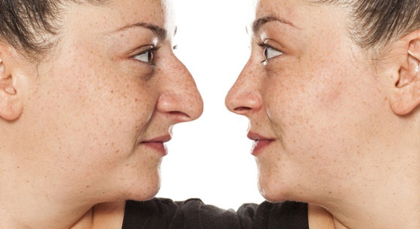 Nasenchirurgie - DDr. Hubert Ofner - Kieferchirurg Linz 4020