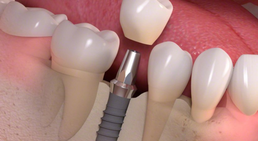 Implantologie - DDr. Hubert Ofner - Kieferchirurg Linz 4020