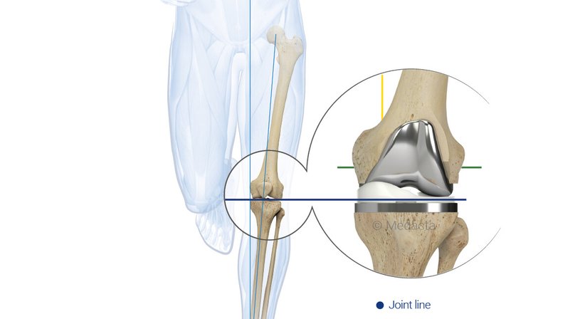 Knieprothese - Operation - OA Dr. Lorenz Pötz - Orthopäde Wien 1060