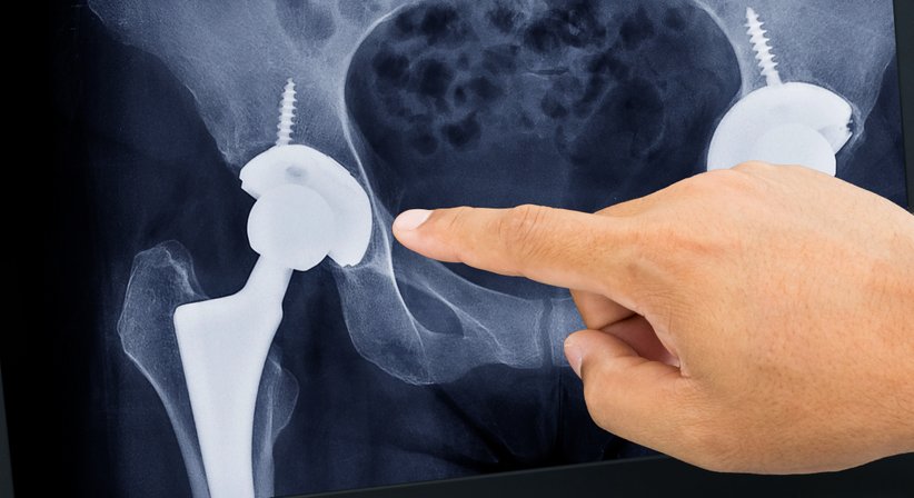 Hüftprothese - Wechseloperation - OA Dr. Lorenz Pötz - Orthopäde Wien 1060