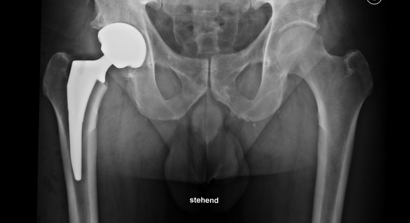 Hüftprothese - Operation - OA Dr. Lorenz Pötz - Orthopäde Wien 1060