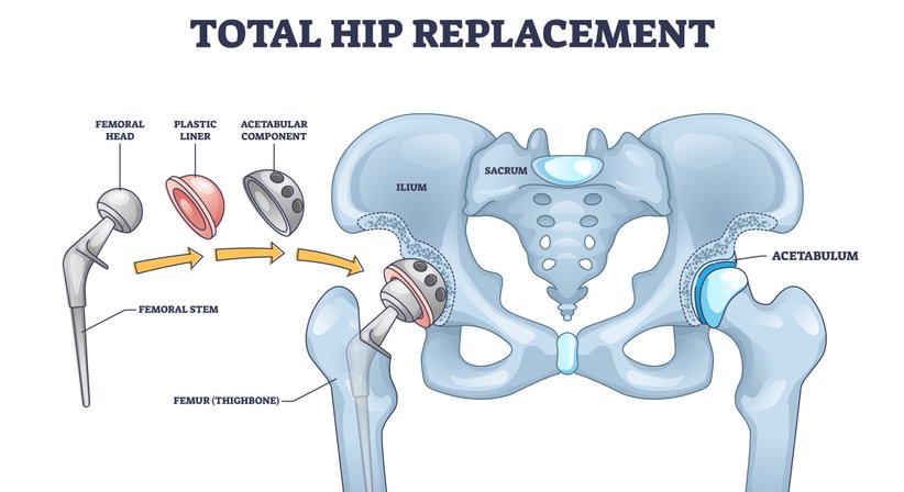 Hüftprothese - Operation - OA Dr. Lorenz Pötz - Orthopäde Wien 1060