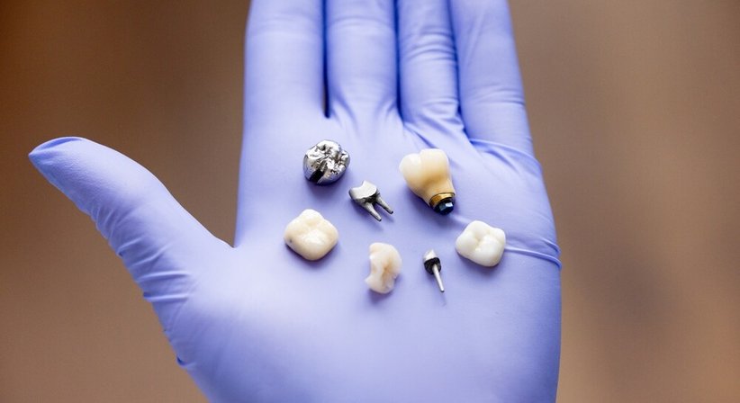 Implantologie bei Dr. med. dent. Matthias Göstel