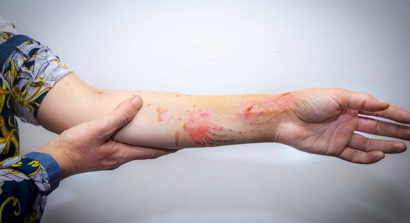 Narbenkorrektur - Dr. Harald Kubiena - Plastischer Chirurg Wien 1190