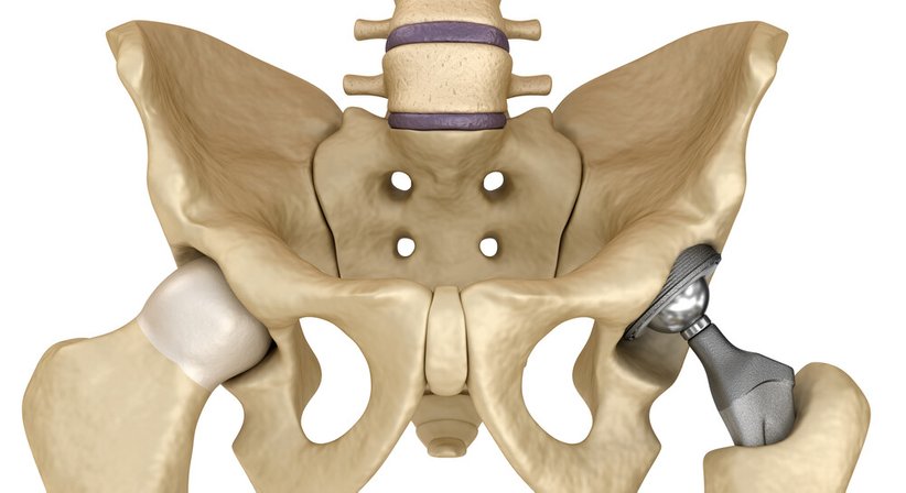 Computergestützte 3D Operationsplanung - OA Dr. Markus Winnisch, MSc - Orthopäde Rauris 5661