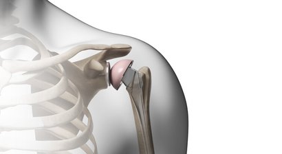 Schulterprothese (Einsatz eines künstlichen Schultergelenks)