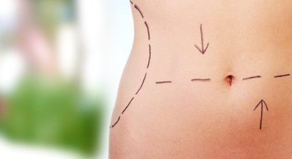 Bauchdeckenstraffung