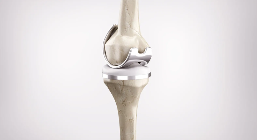 Endoprothetik - Dr. med. univ. Richard Kellner - Orthopäde Zillingdorf 2491