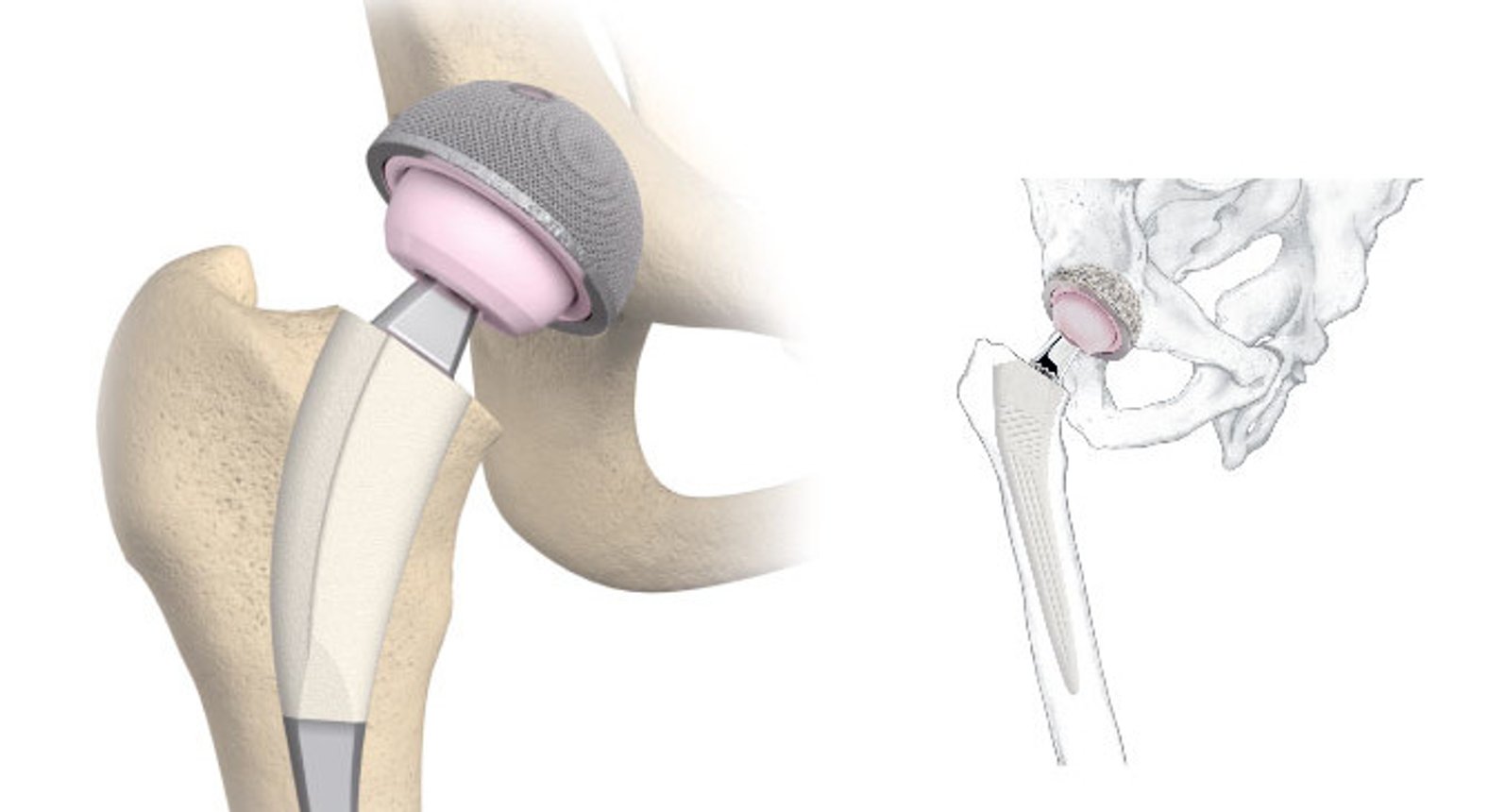 Dr. Erdal Cetin - Hüftprothese | Orthopäde in 1110 Wien - DocFinder.at