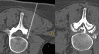 Interventionelle Schmerztherapie