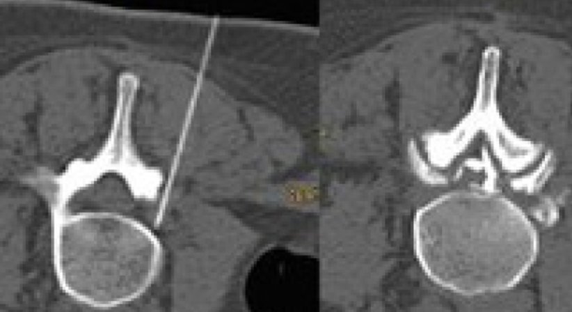 Interventionelle Schmerztherapie - Priv.Doz. Dr. Markus Reiter - Radiologe Wien 1140