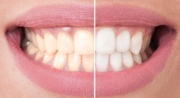 Bleaching -