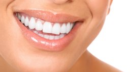 Veneers -