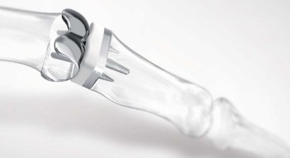 Fingergelenksarthrosen