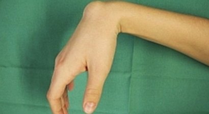 Ganglion (Überbein)