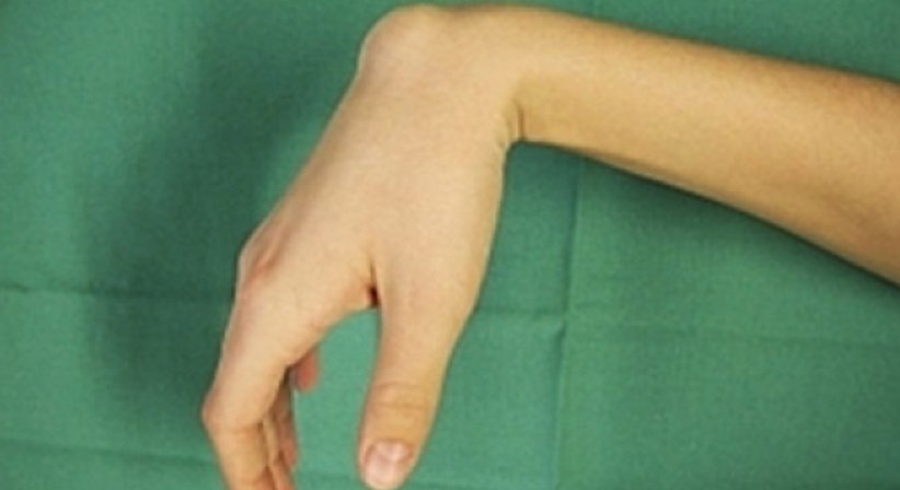 Ganglion (Überbein) - Univ.-Prof. Dr. Hugo Benito Kitzinger - Schwerpunkt: Handchirurgie Wien 1190