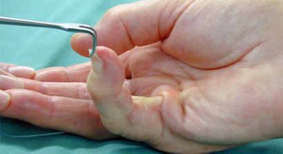 Morbus Dupuytren (Verkrümmung der Finger)