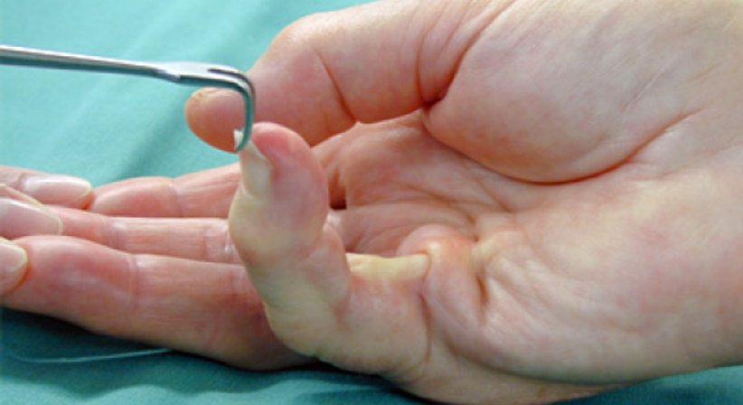 Morbus Dupuytren (Verkrümmung der Finger) - Univ.-Prof. Dr. Hugo Benito Kitzinger - Schwerpunkt: Handchirurgie Wien 1190