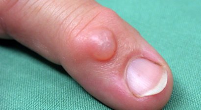 Mukoidzyste (Ganglion am Fingergelenk)