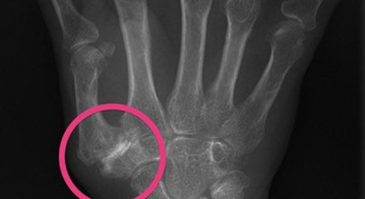 Rhizarthrose (Daumensattelgelenkarthrose, Daumenarthrose)