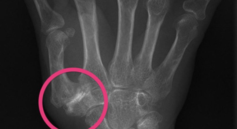 Rhizarthrose (Daumensattelgelenkarthrose, Daumenarthrose) - Univ.-Prof. Dr. Hugo Benito Kitzinger - Schwerpunkt: Handchirurgie Wien 1190