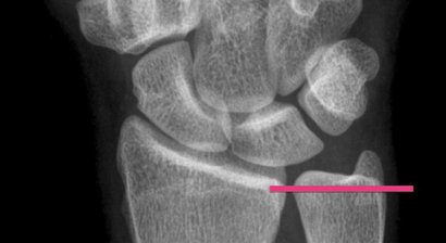 Überlänge der Elle (Ulna Impaction Syndrom)