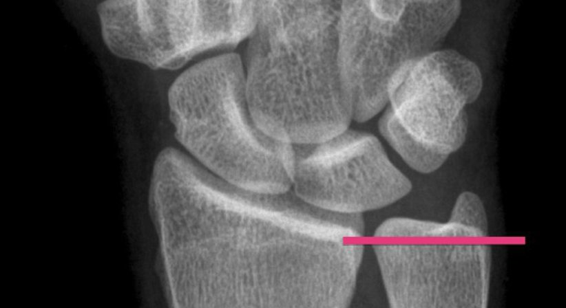 Überlänge der Elle (Ulna Impaction Syndrom) - Univ.-Prof. Dr. Hugo Benito Kitzinger - Schwerpunkt: Handchirurgie Wien 1190