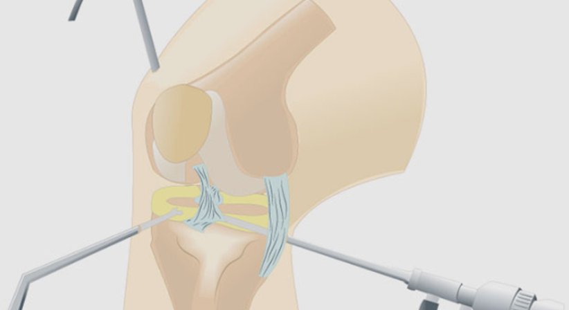 Arthroskopie - Dr. Gerhard Kainz - Orthopäde Wien 1130