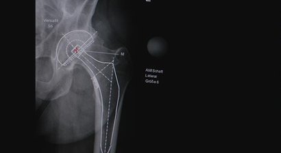 Künstliches Hüftgelenk (nach der minimal invasiven AMIS-Methode)