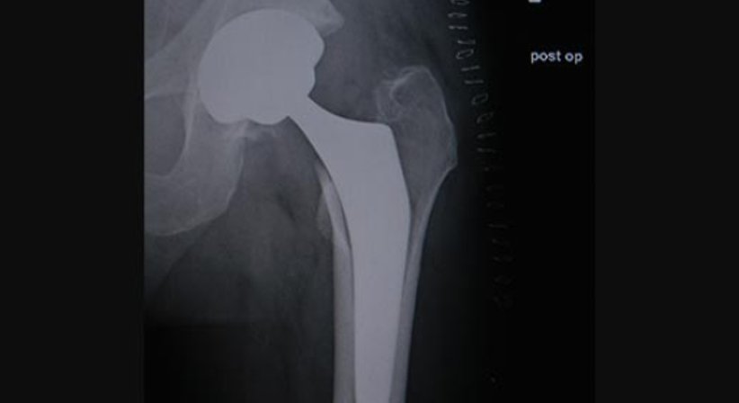 Künstliches Hüftgelenk (nach der minimal invasiven AMIS-Methode) - Dr. Gerhard Kainz - Orthopäde Wien 1130