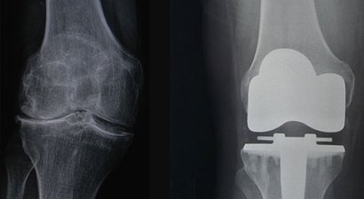 Künstliches Kniegelenk