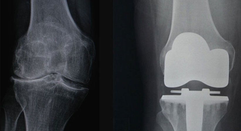 Künstliches Kniegelenk - Dr. Gerhard Kainz - Orthopäde Wien 1130