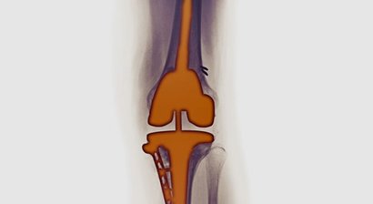 Wechsel von Kunstgelenken (Revisionsendoprothetik)