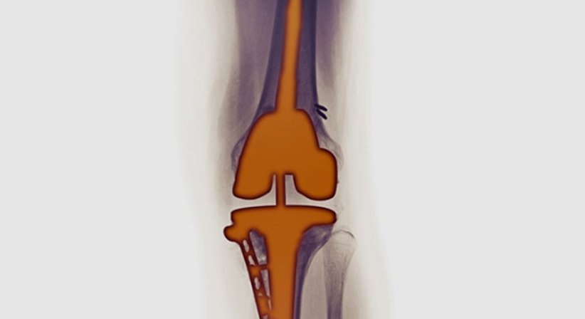 Wechsel von Kunstgelenken (Revisionsendoprothetik) - Dr. Gerhard Kainz - Orthopäde Wien 1130