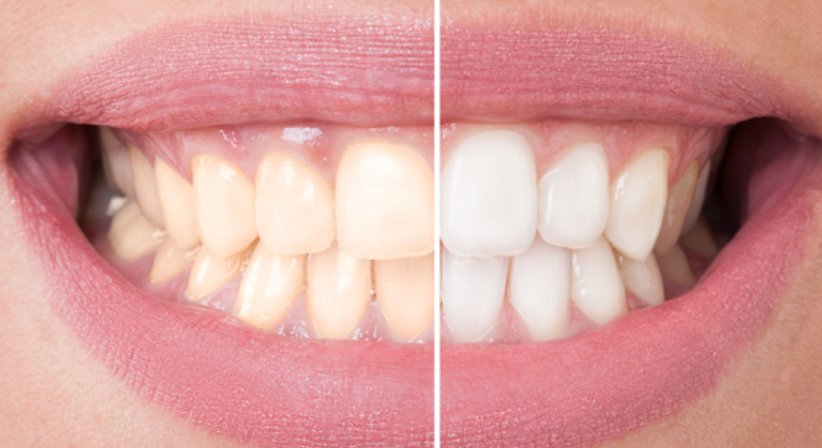 Bleaching - DDr. Karin Vornwagner - Zahnärztin Wien 1170