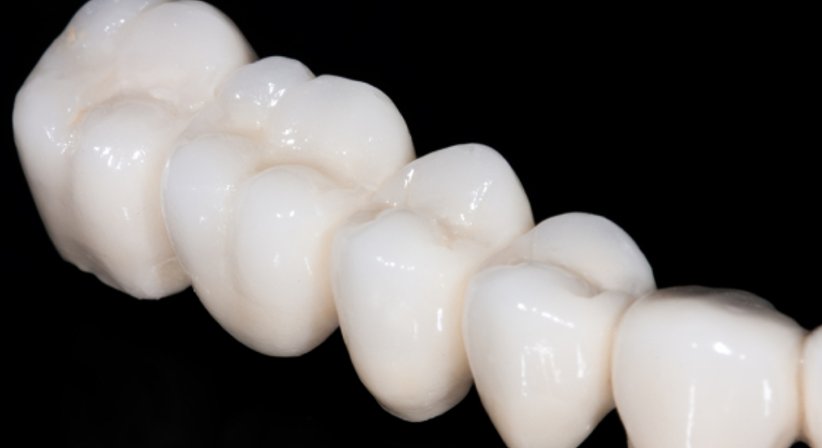 Krone/Brücke/Inlay - DDr. Karin Vornwagner - Zahnärztin Wien 1170