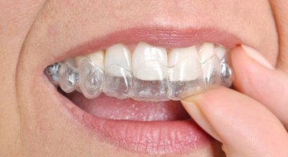 Unsichtbare Zahnspange