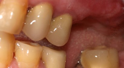 Implantologie und Knochenaufbau