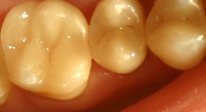 Inlay (Keramikfüllungen)