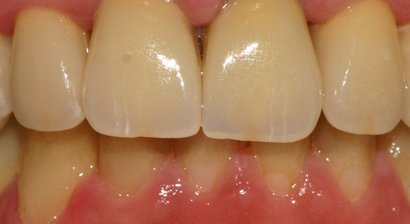 Krone (Keramikkronen)