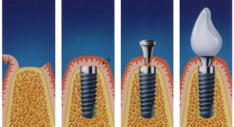 Implantologie - Dr. Michael Knoll - Zahnarzt Salzburg 5020