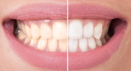 Bleaching -