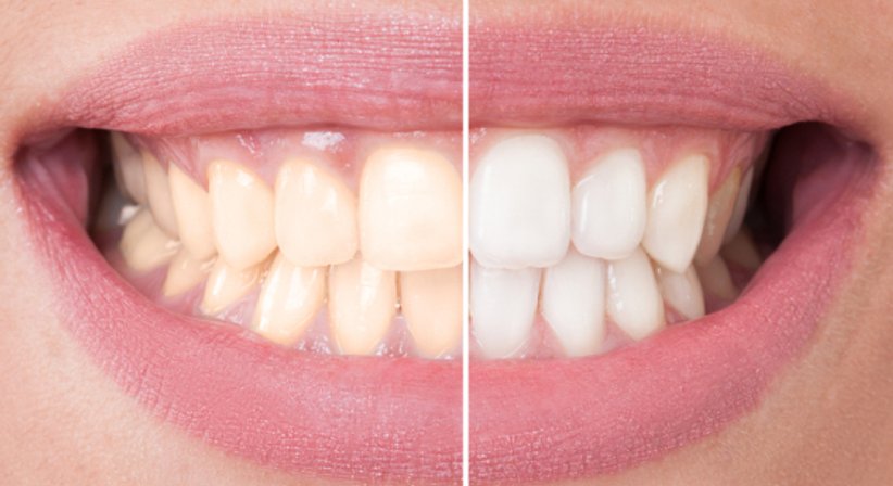 Bleaching - Dr.med.univ. Michael Truppe - Zahnarzt Wien 1080