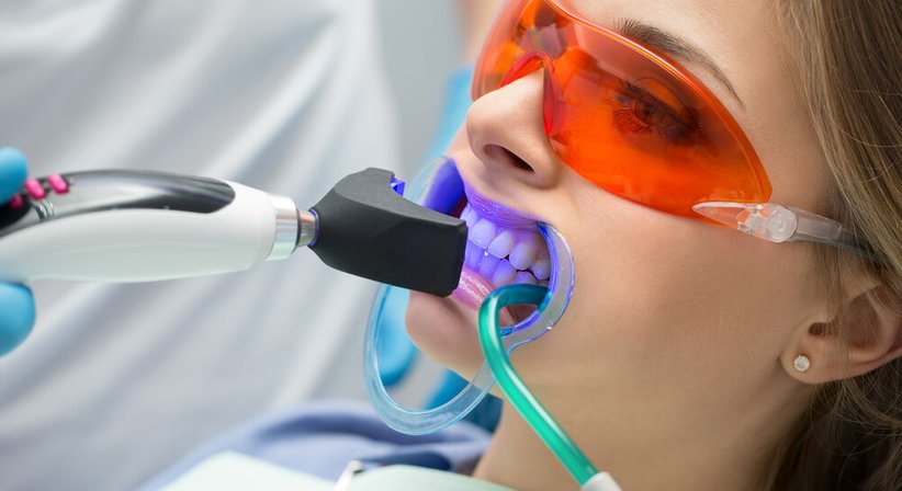 Bleaching - Dr. med.dent. Thomas Schillinger - Zahnarzt Wien 1130