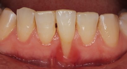 Parodontalbehandlung