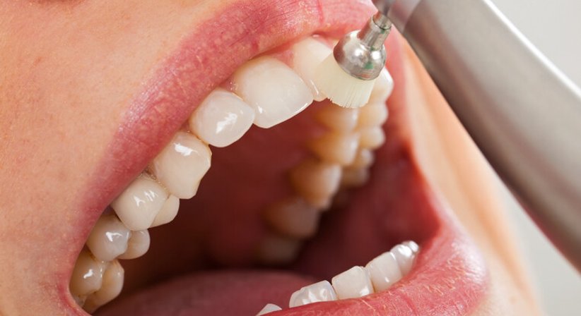 Professionelle Mundhygiene - Dr. med.dent. Thomas Schillinger - Zahnarzt Wien 1130